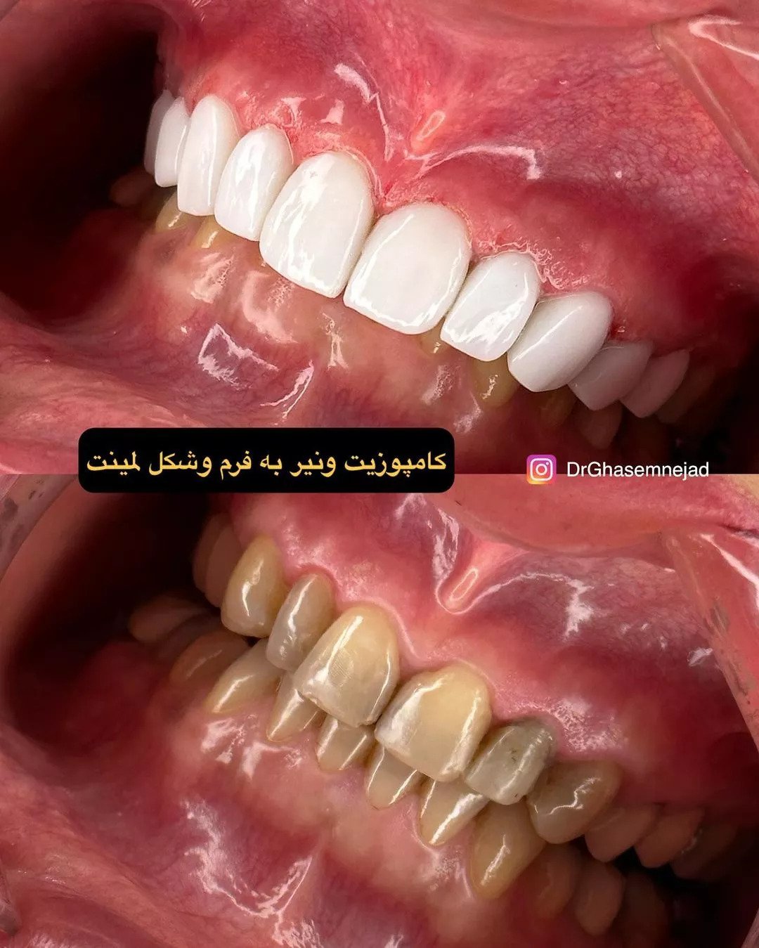 قبل و بعد کامپوزیت